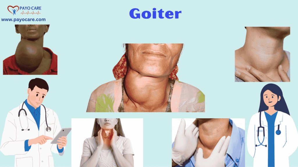 Goiter: Types, Causes, Symptoms, Prevention,