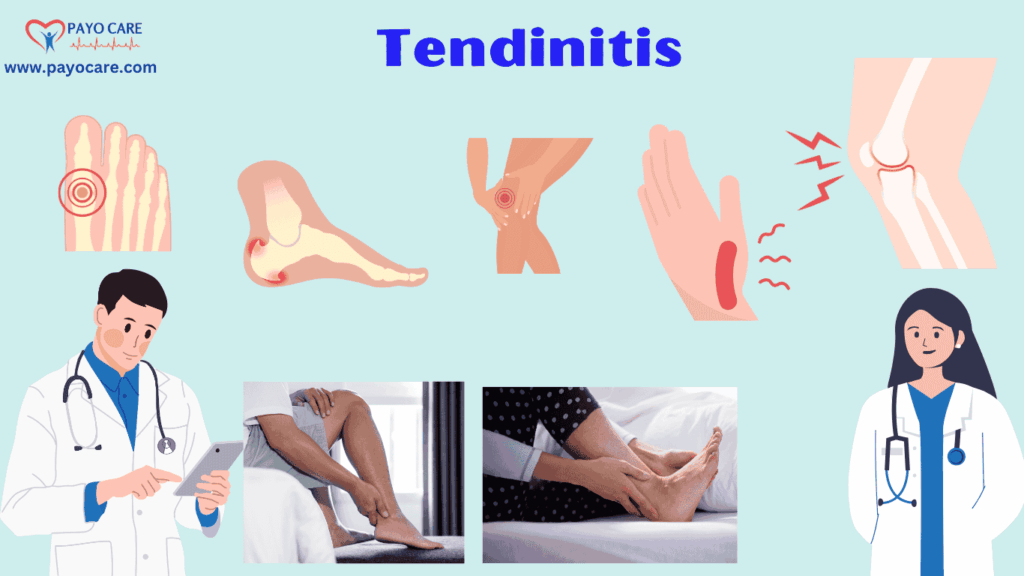 Tendinitis: Types, Causes, Symptoms, Prevention, Diagnosis & Treatment Tendinitis: Types, Causes, Symptoms, Prevention, Diagnosis & Treatment