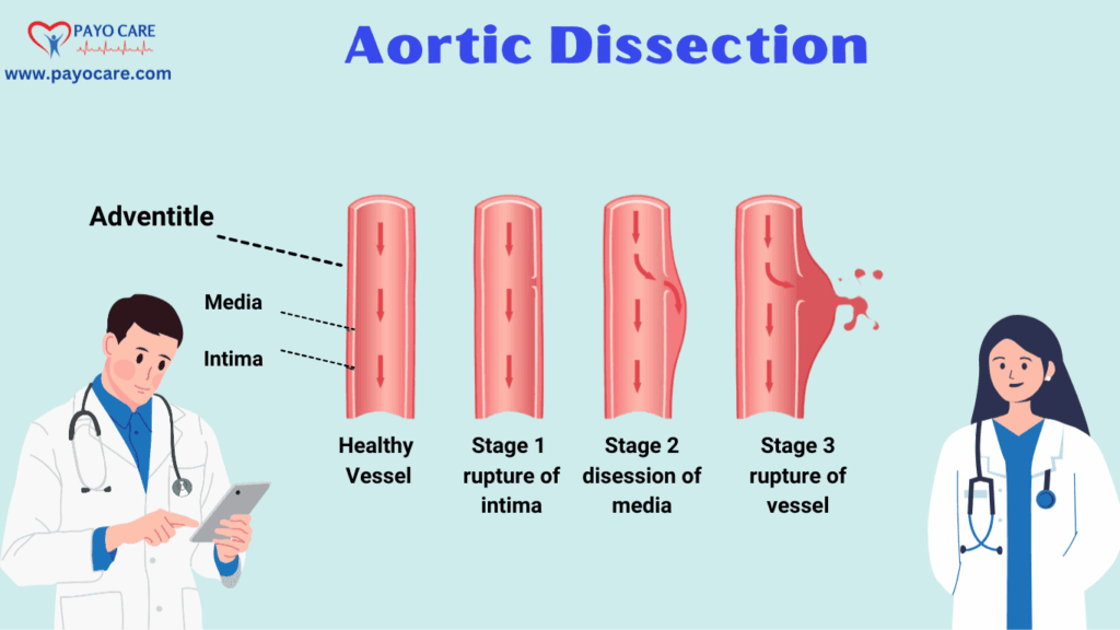 Aortic Dissection: Types, Causes and Treatment Aortic Dissection: Types, Causes and Treatment