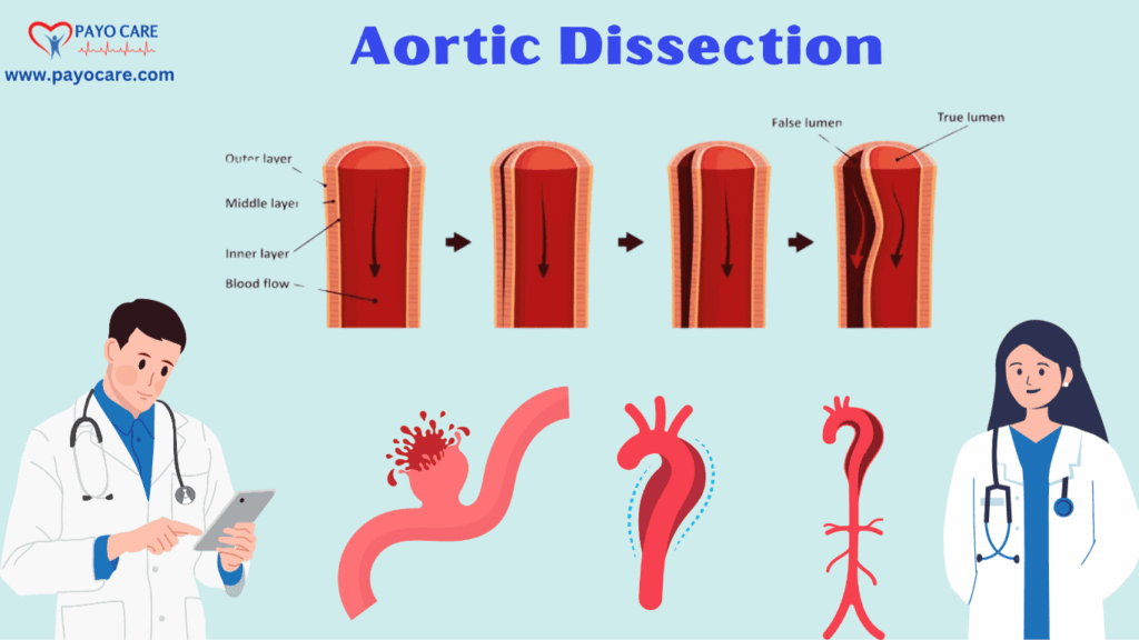 Aortic Dissection: Types, Causes, Symptoms, Prevention, Diagnosis, and Treatment Aortic Dissection: Types, Causes, Symptoms, Prevention, Diagnosis, and Treatment