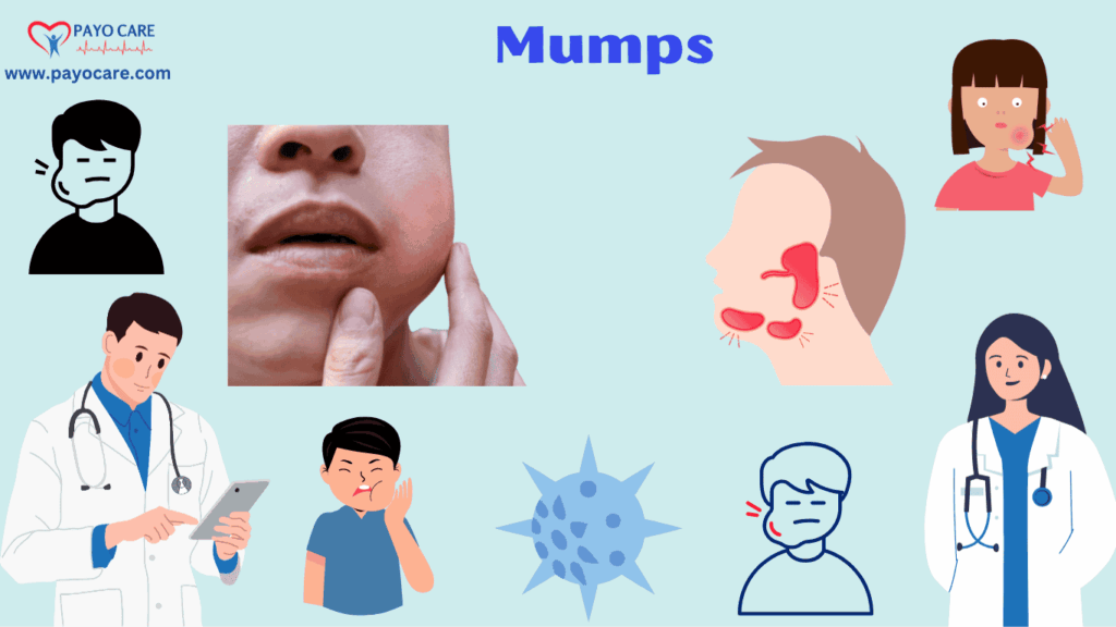 Mumps: Types, Causes, Symptoms, Prevention, Diagnosis, and Treatment Mumps: Types, Causes, Symptoms, Prevention, Diagnosis, and Treatment