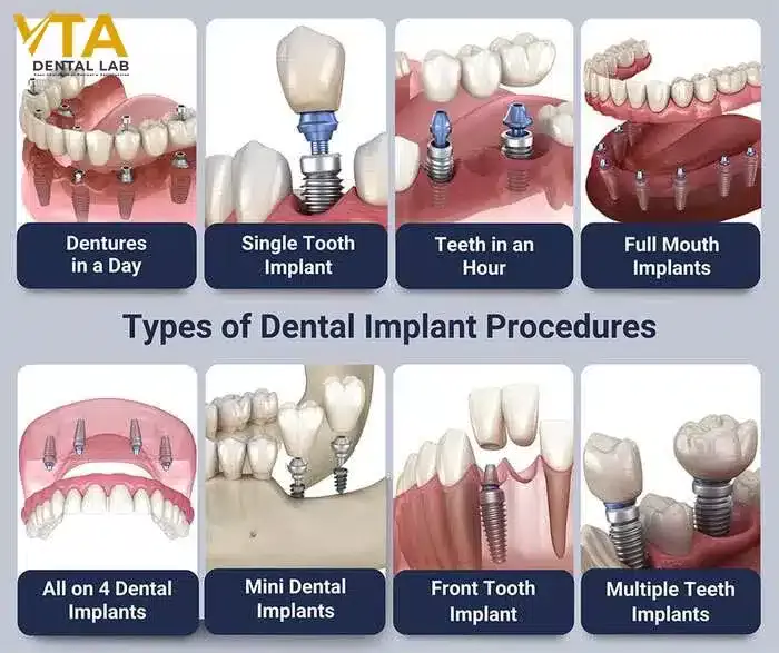 dental-implants-cost-2